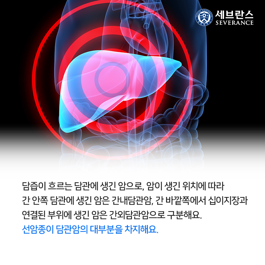 담즙이 흐르는 담관에 생긴 암으로, 암이 생긴 위치에 따라 간 안쪽 담관에 생긴 암은 간내담관암, 간 바깥쪽에서 십이지장과 연결된 부위에 생긴 암은 간외담관암으로 구분해요. 선암종이 담관암의 대부분을 차지해요. 