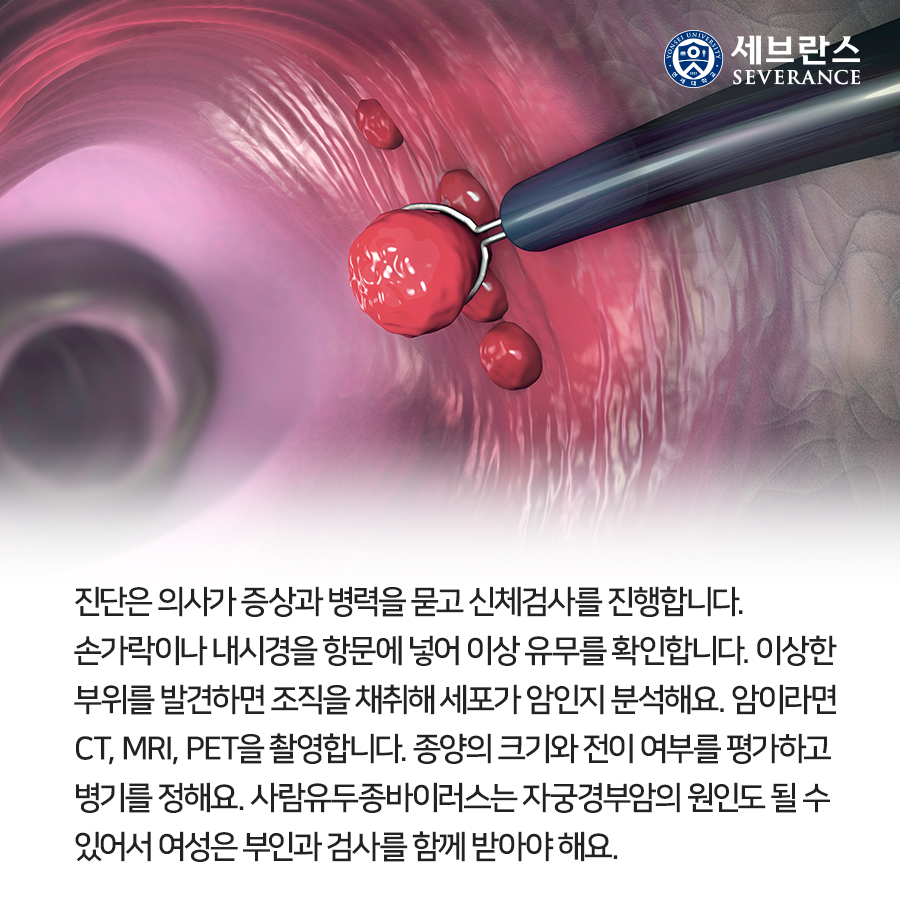 진단은 의사가 증상과 병력을 묻고 신체검사를 진행합니다. 손가락이나 내시경을 항문에 넣어 이상 유무를 확인합니다. 이상한 부위를 발견하면 조직을 채취해 세포가 암인지 분석해요.  암이라면 CT, MRI, PET을 촬영합니다. 종양의 크기와 전이 여부를 평가하고 병기를 정해요. 사람유두종바이러스는 자궁경부암의 원인도 될 수 있어서 여성은 부인과 검사를 함께 받아야 해요.