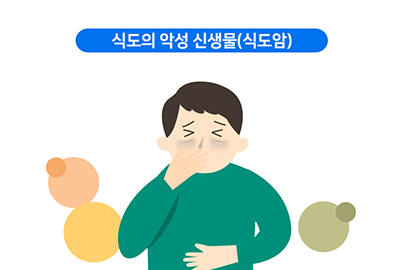 식도암